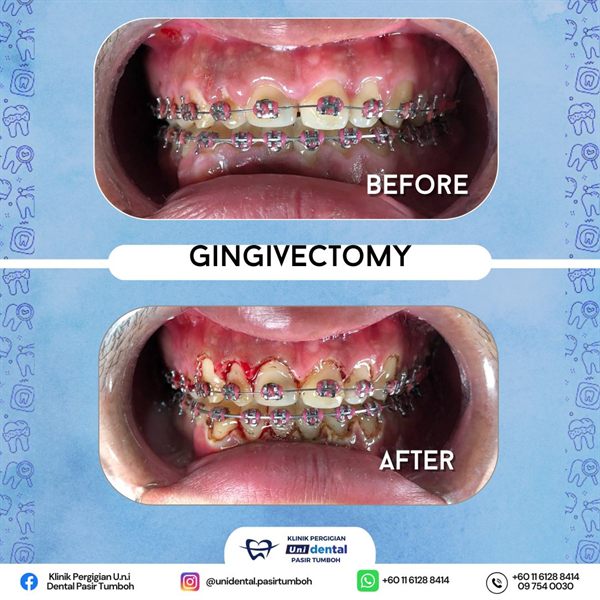 Sebelum dan selepas rawatan: Gingivectomy