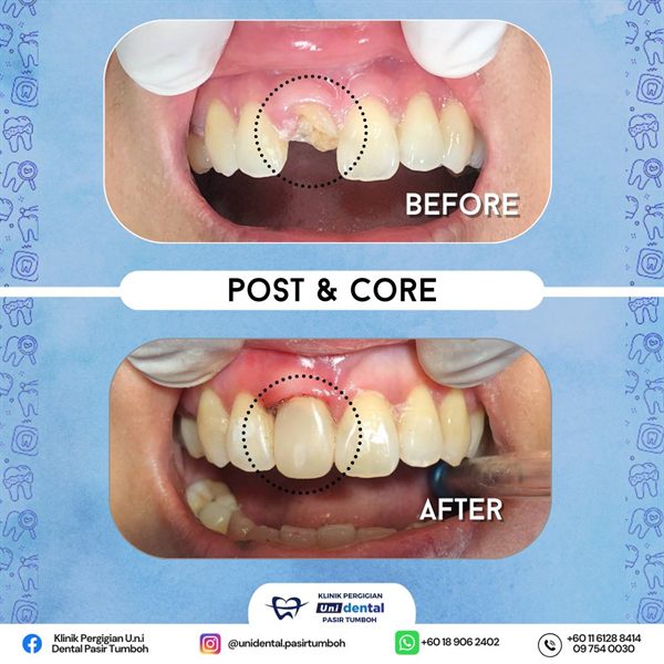 Sebelum dan selepas rawatan: Post & Core