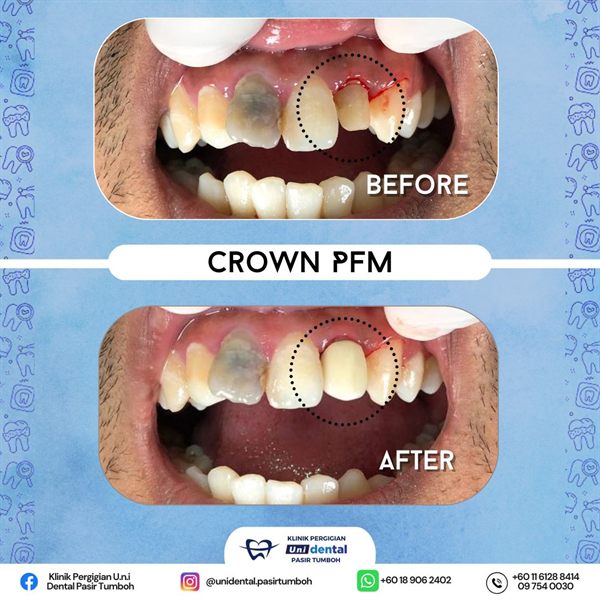 Sebelum dan selepas rawatan: Crown PFM