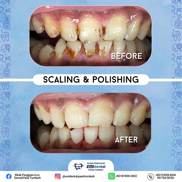 Sebelum dan selepas rawatan: Scaling & Polishing