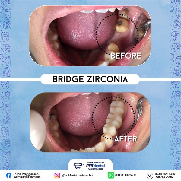 Sebelum dan selepas rawatan: Bridge Zirconia