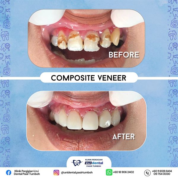 Sebelum dan selepas rawatan: Composite Veneer